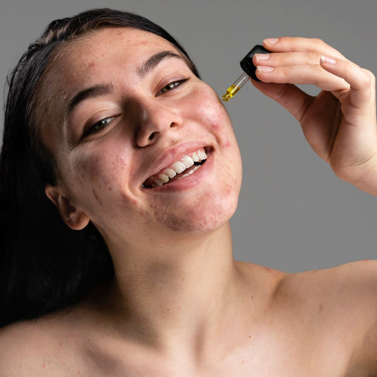 niacinamide for acne
