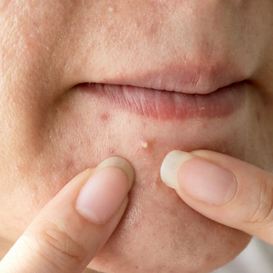 hormonal acne skincare routine