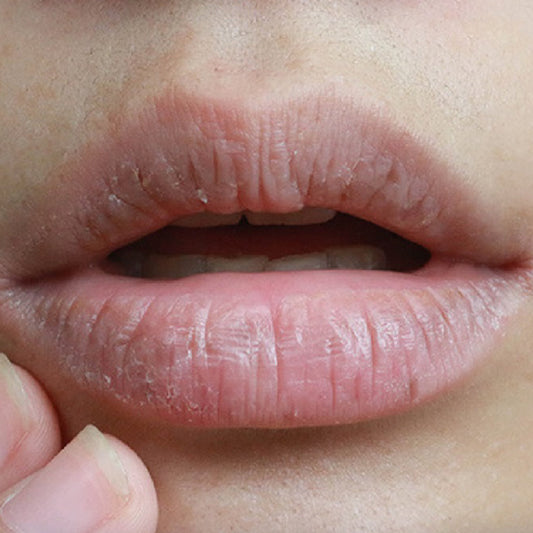 Dehydration Dry Lips, Never Again!