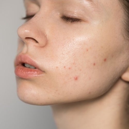 why acne keep coming