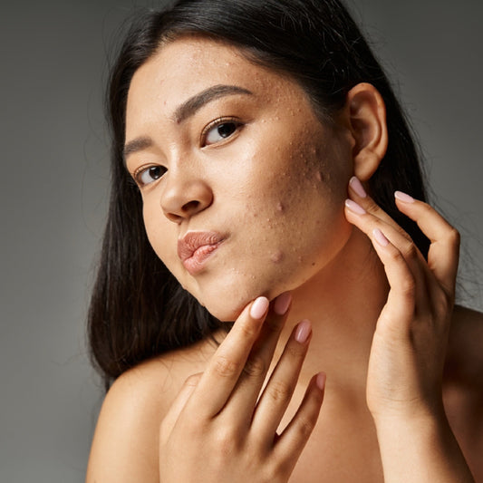 Which acne treatment